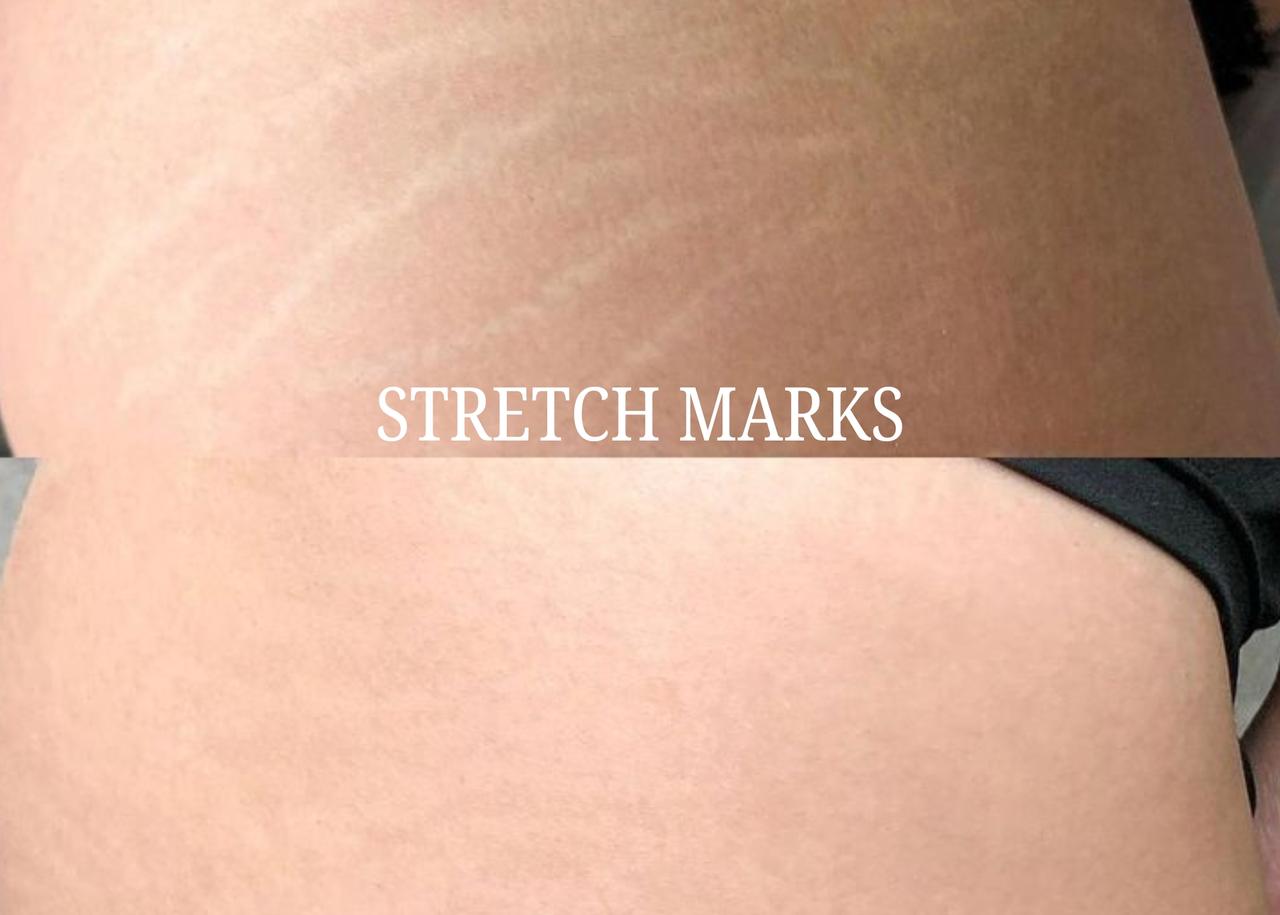 Stretch Mark Revision Results